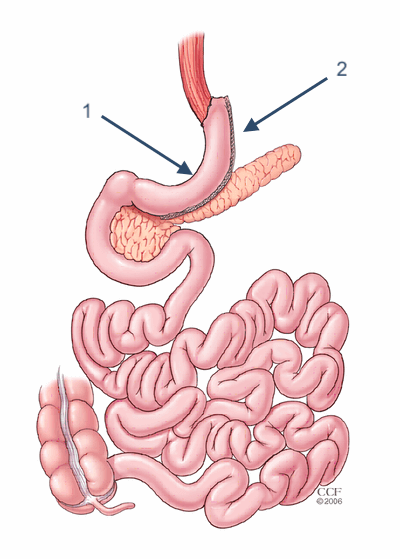 Sleeve Gastrectomy