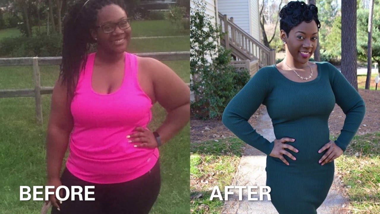 Bariatric Surgery Before & After Photos